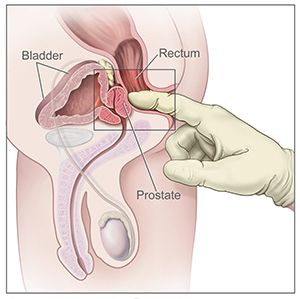 A drawing shows a gloved finger placed inside the rectum. The rectum, bladder and prostate are shown and labeled.